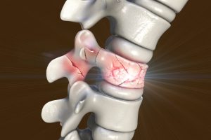 spinal fracture treatment near me